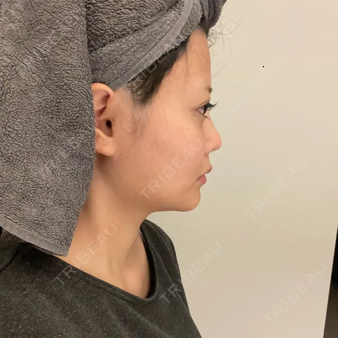 糸リフト / あご下筋肉縛り WOM CLINIC GINZA （ワム クリニック ギンザ） DAY 19 メイン用