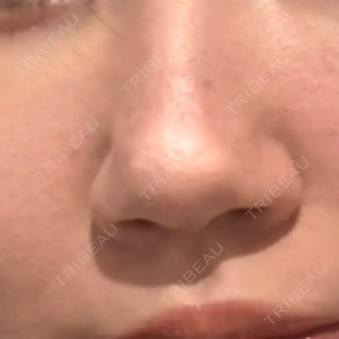 ボトックス（エラ・小顔） / ハイフ（顔） / ほくろ・いぼ除去レーザー（肌） 共立美容外科 福岡院 AFTER メイン用