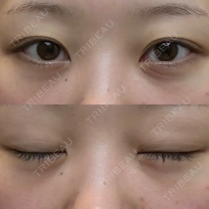 クマ治療 / 脂肪注入（目の下） 湘南美容クリニック 千葉センシティ院 AFTER メイン用