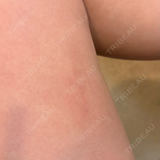 クマ治療 / 脂肪注入（目の下） 湘南美容クリニック 千葉センシティ院 DAY 31 メイン用