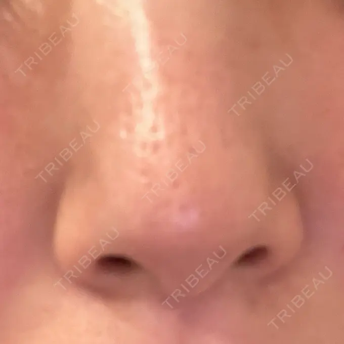 ピーリング（ニキビ・毛穴） / LED治療 東京素肌クリニック 新宿院 AFTER メイン用