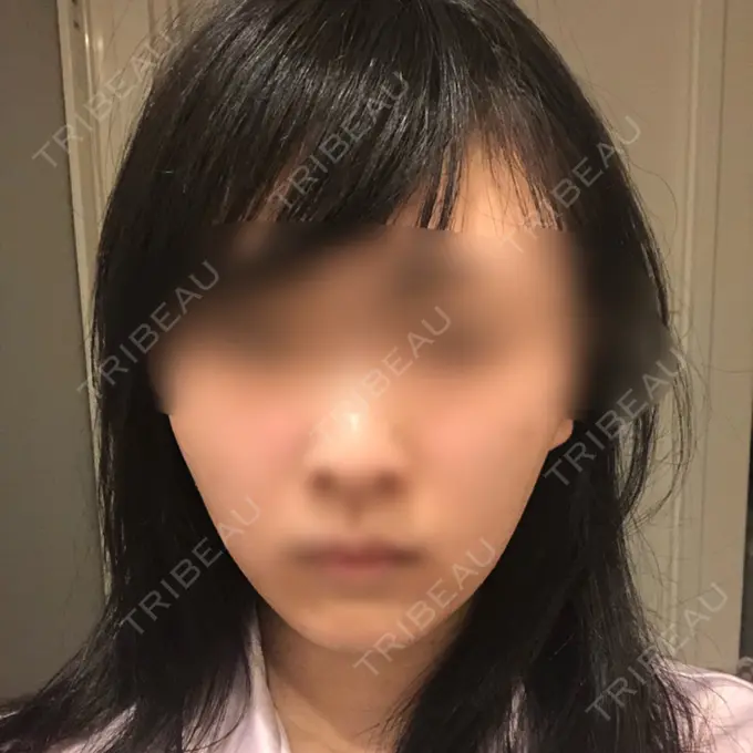 バッカルファット除去 / 脂肪吸引（顔） / ヒアルロン酸注入（鼻） / ボトックス（あご） / 水光注射（ハリ・美肌） / ボトックス（エラ・小顔） / ボトックス（口角） / 白玉点滴・注射 エートップ美容整形外科 AFTER メイン用