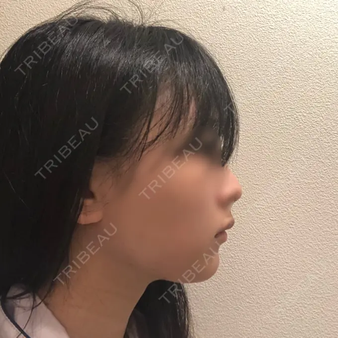 バッカルファット除去 / 脂肪吸引（顔） / ヒアルロン酸注入（鼻） / ボトックス（あご） / 水光注射（ハリ・美肌） / ボトックス（エラ・小顔） / ボトックス（口角） / 白玉点滴・注射 エートップ美容整形外科 DAY 96 メイン用