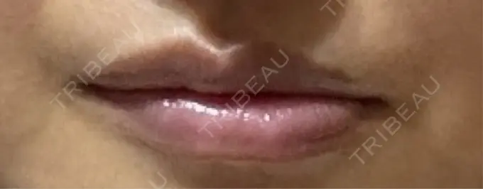 ヒアルロン酸注入（唇） アネシス美容クリニック AFTER メイン用
