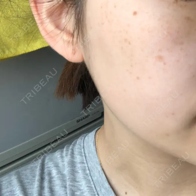 シミ取りレーザー 野口皮膚科医院 DAY 12 メイン用