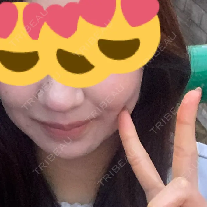 ボトックス（エラ・小顔） AYANAフィラーズクリニック 渋谷院 AFTER メイン用