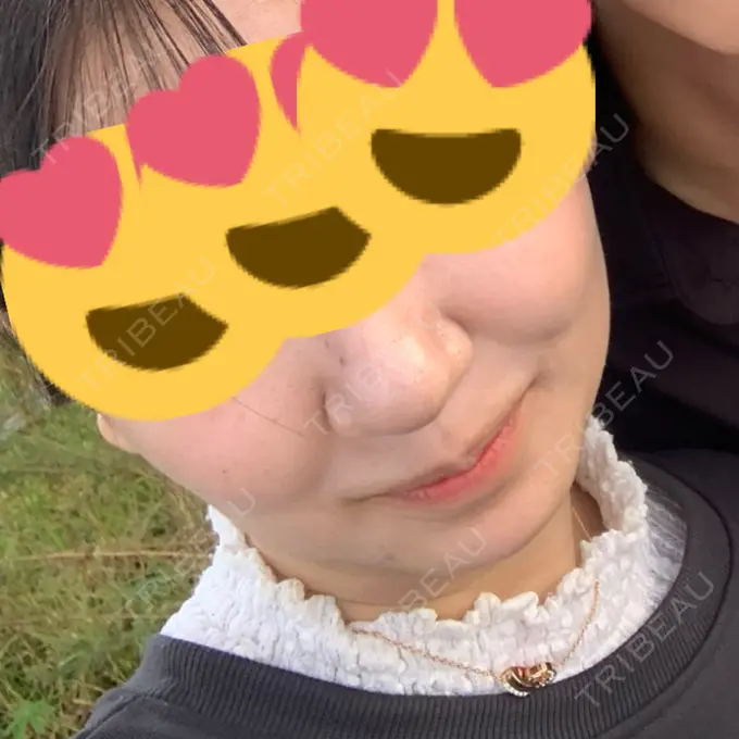 ボトックス（エラ・小顔） ドクター松井クリニック 新宿 AFTER メイン用