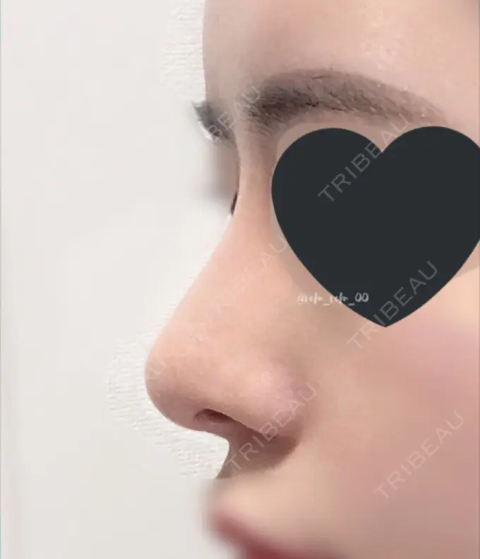 鼻尖形成（切開） / 鼻中隔延長（切開） / 軟骨移植 / 眉間プロテーゼ / 鼻修正 ミナ美容外科 DAY 120 メイン用