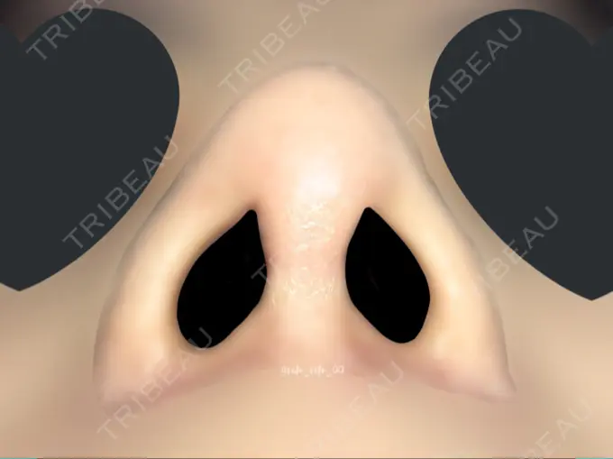 鼻尖形成（切開） / 鼻中隔延長（切開） / 軟骨移植 / 眉間プロテーゼ / 鼻修正 ミナ美容外科 DAY 120 メイン用