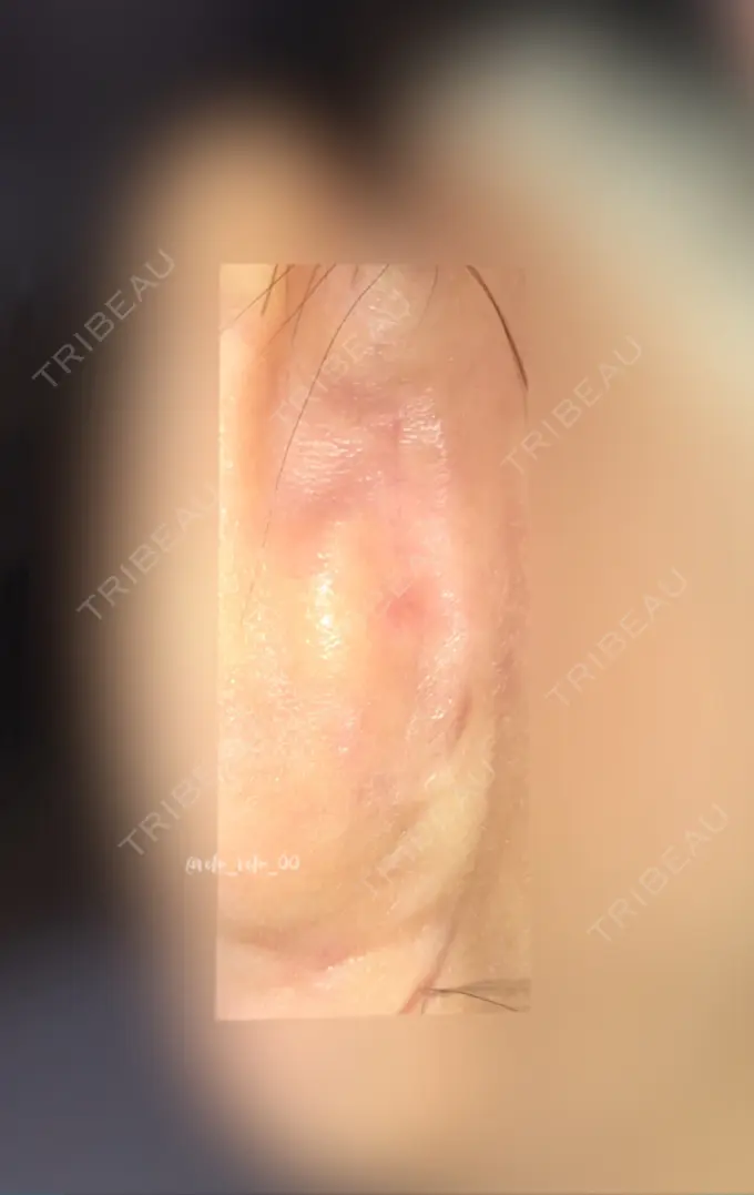 鼻尖形成（切開） / 鼻中隔延長（切開） / 軟骨移植 / 眉間プロテーゼ / 鼻修正 ミナ美容外科 DAY 120 メイン用