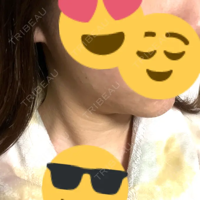 インモード 東京美容皮膚科アロエクリニック池袋 DAY 33 メイン用