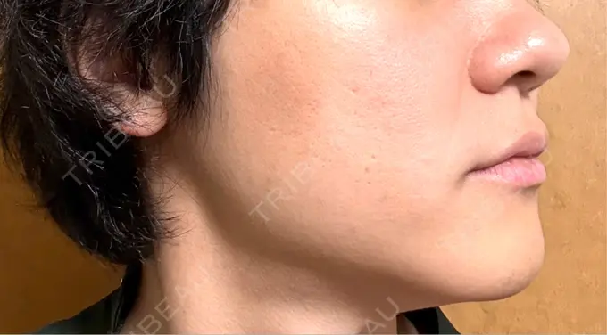 糸リフト / 肌ヒアルロン酸注入（たるみ・シワ改善） アイネクリニック　川崎院 DAY 38 メイン用