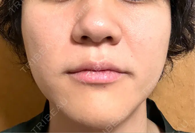 糸リフト / 肌ヒアルロン酸注入（たるみ・シワ改善） アイネクリニック　川崎院 AFTER メイン用