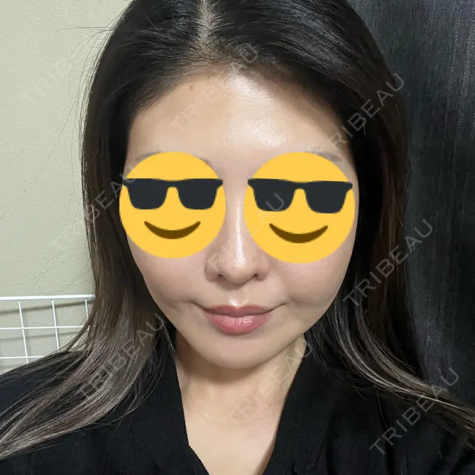 糸リフト / バッカルファット除去 / 脂肪吸引（顔） / ヒアルロン酸注入（頬） eクリニック 福岡院 AFTER メイン用