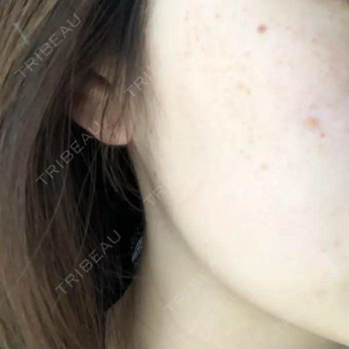 シミ取りレーザー 野口皮膚科医院 DAY 13 メイン用