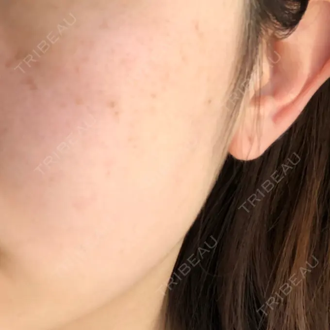 シミ取りレーザー 野口皮膚科医院 DAY 13 メイン用