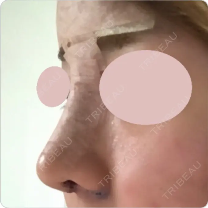 鼻中隔延長（切開） / 小鼻縮小（切開） / 軟骨移植 / 眉間プロテーゼ / 鼻孔縁下降 加美（GAMI）整形外科 DAY 6 メイン用