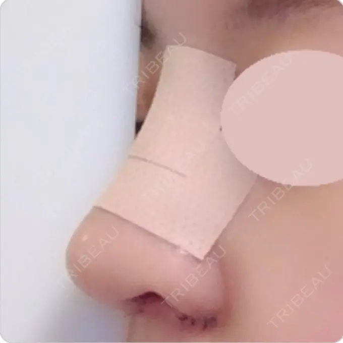 鼻中隔延長（切開） / 小鼻縮小（切開） / 軟骨移植 / 眉間プロテーゼ / 鼻孔縁下降 加美（GAMI）整形外科 DAY 7 メイン用