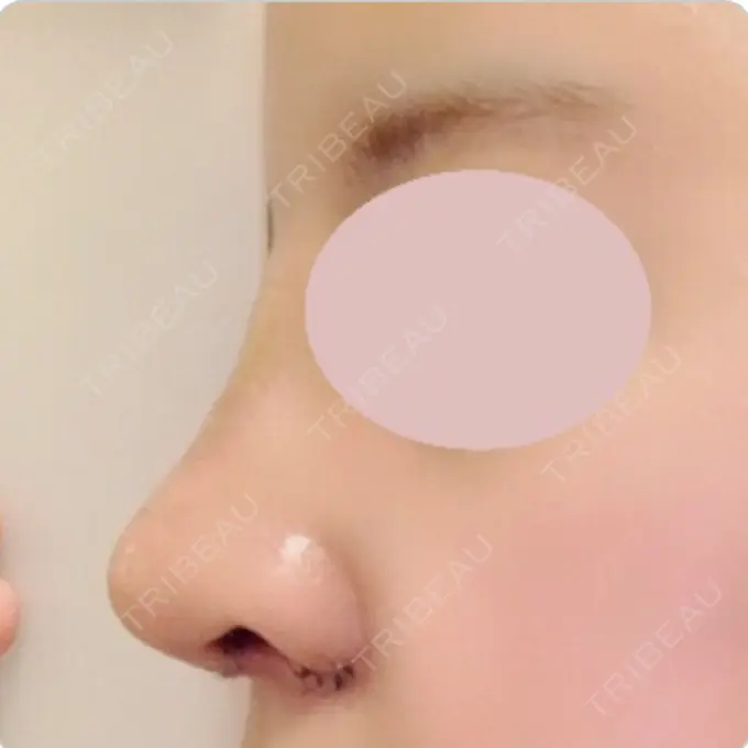 鼻中隔延長（切開） / 小鼻縮小（切開） / 軟骨移植 / 眉間プロテーゼ / 鼻孔縁下降 加美（GAMI）整形外科 DAY 8 メイン用