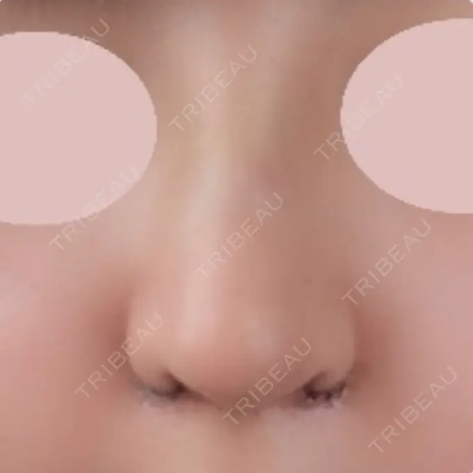 鼻中隔延長（切開） / 小鼻縮小（切開） / 軟骨移植 / 眉間プロテーゼ / 鼻孔縁下降 加美（GAMI）整形外科 DAY 9 メイン用