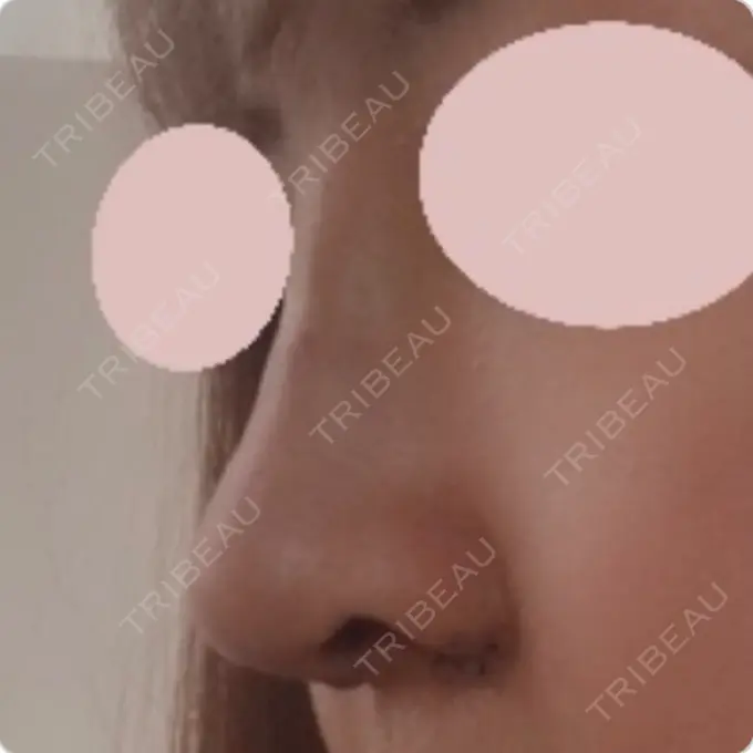 鼻中隔延長（切開） / 小鼻縮小（切開） / 軟骨移植 / 眉間プロテーゼ / 鼻孔縁下降 加美（GAMI）整形外科 DAY 9 メイン用