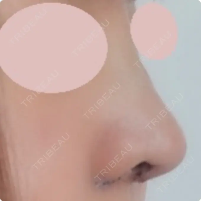 鼻中隔延長（切開） / 小鼻縮小（切開） / 軟骨移植 / 眉間プロテーゼ / 鼻孔縁下降 加美（GAMI）整形外科 DAY 9 メイン用