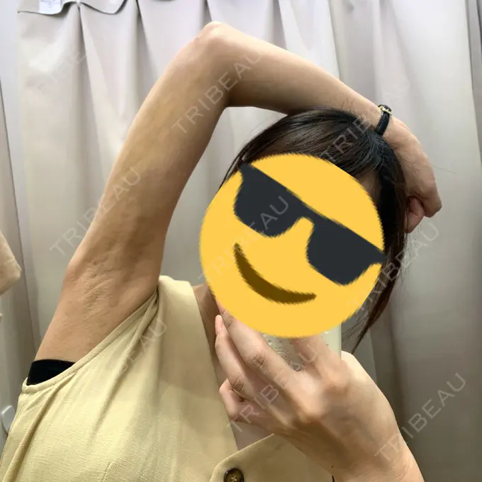 脂肪吸引（二の腕） ジョウクリニック 松山院 DAY 18 メイン用