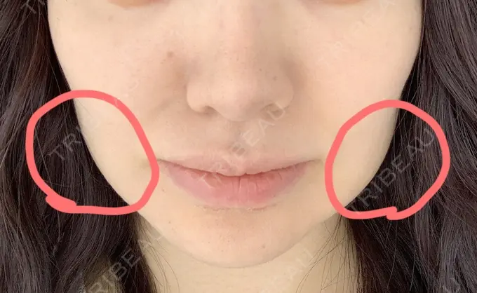 脂肪吸引（顔） / ボトックス（あご） / ヒアルロン酸注入（唇） / ヒアルロン酸溶解 藤・ナチュレ美容クリニック 恵比寿院 AFTER メイン用