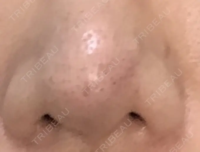 鼻尖形成（切開） 水の森美容クリニック 名古屋院 AFTER メイン用