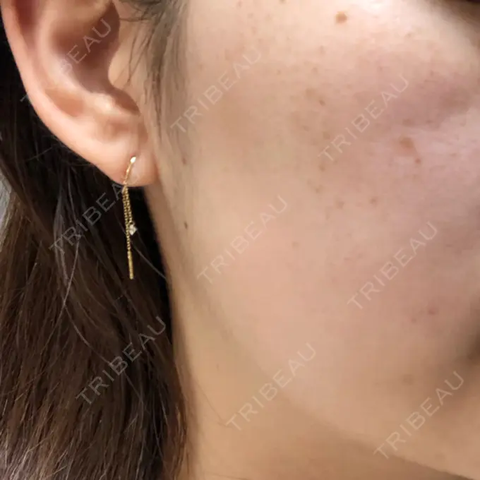 シミ取りレーザー 野口皮膚科医院 DAY 15 メイン用