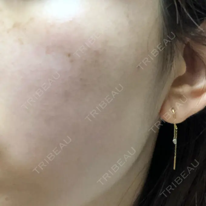 シミ取りレーザー 野口皮膚科医院 DAY 15 メイン用