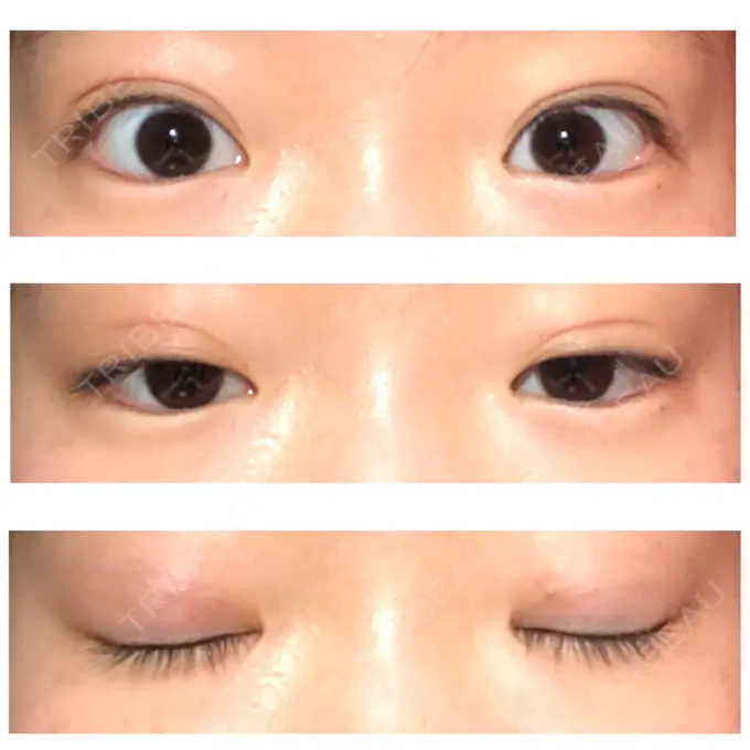 二重埋没 湘南美容クリニック 新宿本院 AFTER メイン用