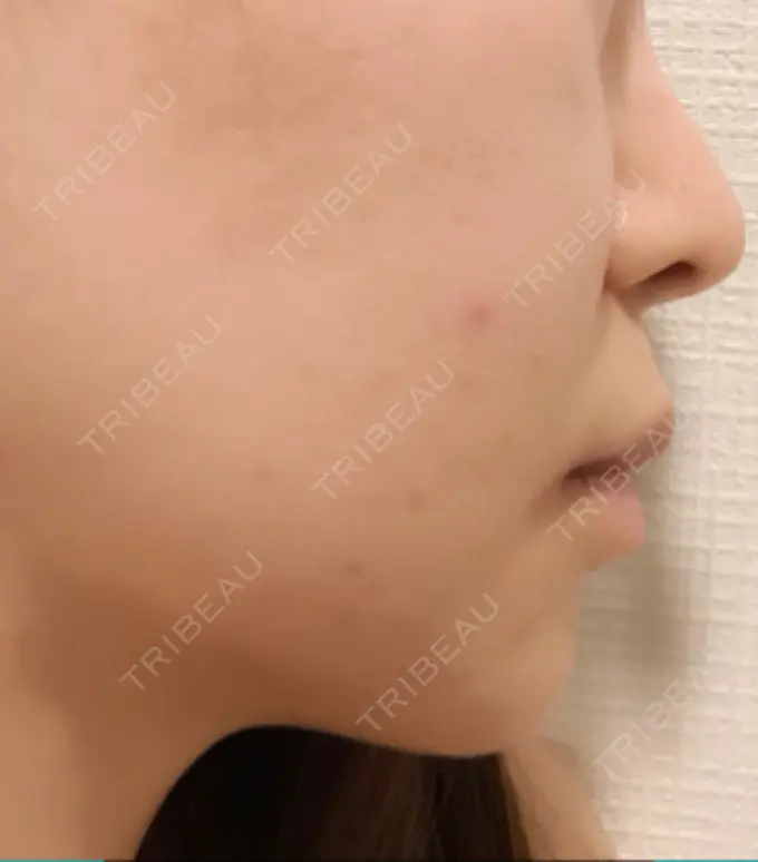 フォトRF 東京美容外科 梅田院 AFTER メイン用