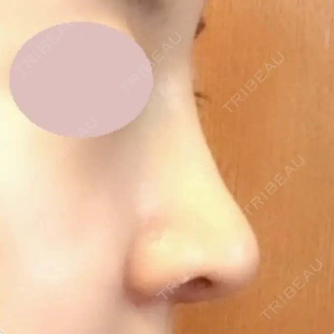 鼻中隔延長（切開） / 小鼻縮小（切開） / 軟骨移植 / 眉間プロテーゼ / 鼻孔縁下降 加美（GAMI）整形外科 DAY 13 メイン用