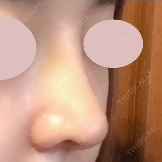 鼻中隔延長（切開） / 小鼻縮小（切開） / 軟骨移植 / 眉間プロテーゼ / 鼻孔縁下降 加美（GAMI）整形外科 DAY 13 メイン用