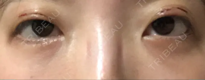 クマ治療 / 下まぶたの脂肪取り / 脂肪注入（肌） / 肌ヒアルロン酸注入（たるみ・シワ改善） 湘南美容クリニック 八王子院 DAY 23 メイン用