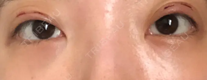 クマ治療 / 下まぶたの脂肪取り / 脂肪注入（肌） / 肌ヒアルロン酸注入（たるみ・シワ改善） 湘南美容クリニック 八王子院 DAY 24 メイン用