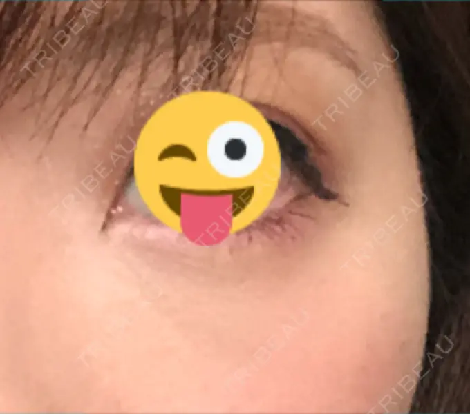 クマ治療 / 下まぶたの脂肪取り / 脂肪注入（肌） / 肌ヒアルロン酸注入（たるみ・シワ改善） 湘南美容クリニック 八王子院 DAY 26 メイン用