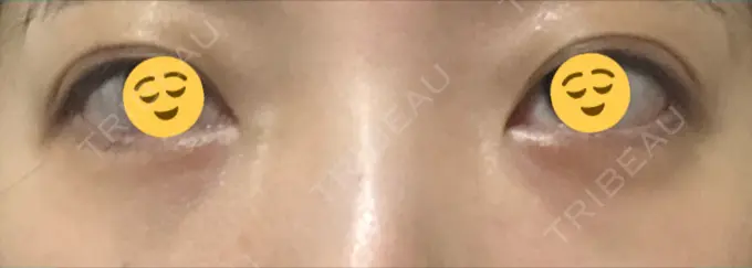 クマ治療 / 下まぶたの脂肪取り / 脂肪注入（肌） / 肌ヒアルロン酸注入（たるみ・シワ改善） 湘南美容クリニック 八王子院 DAY 27 メイン用