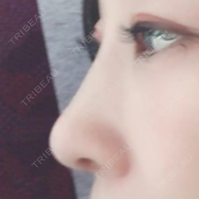 隆鼻術 / 鼻尖形成（切開） / 鼻中隔延長（切開） / 骨切幅寄せ / ワシ鼻修正・ハンプ切除 / ヒアルロン酸溶解 ミナ美容外科 DAY 60 メイン用