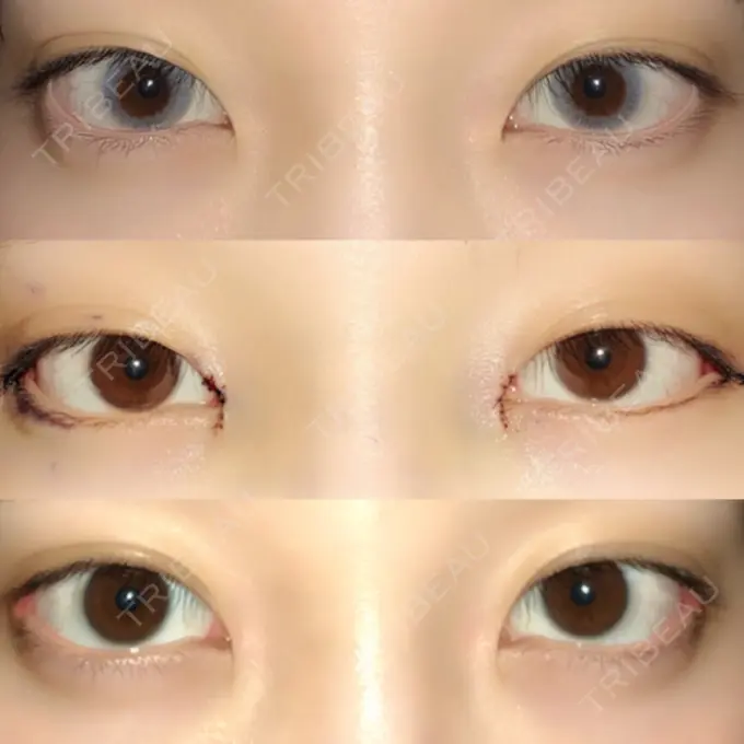 目頭切開 / 目尻切開 エートップ美容整形外科 DAY 66 メイン用