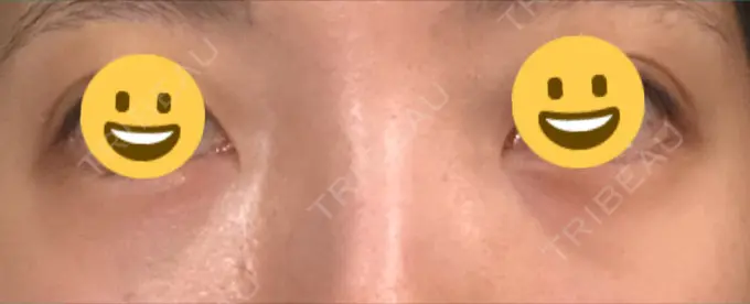 クマ治療 / 下まぶたの脂肪取り / 脂肪注入（肌） / 肌ヒアルロン酸注入（たるみ・シワ改善） 湘南美容クリニック 八王子院 DAY 28 メイン用