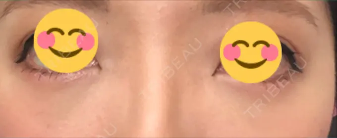 クマ治療 / 下まぶたの脂肪取り / 脂肪注入（肌） / 肌ヒアルロン酸注入（たるみ・シワ改善） 湘南美容クリニック 八王子院 DAY 29 メイン用