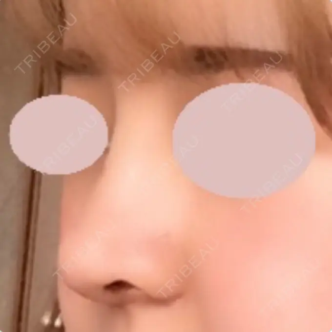 鼻中隔延長（切開） / 小鼻縮小（切開） / 軟骨移植 / 眉間プロテーゼ / 鼻孔縁下降 加美（GAMI）整形外科 AFTER メイン用