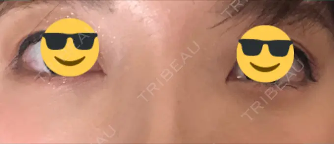 クマ治療 / 下まぶたの脂肪取り / 脂肪注入（肌） / 肌ヒアルロン酸注入（たるみ・シワ改善） 湘南美容クリニック 八王子院 DAY 30 メイン用