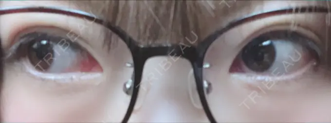 二重埋没 共立美容外科 大宮院 DAY 0 メイン用