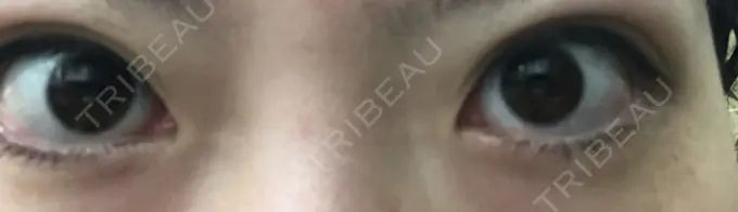 二重埋没 共立美容外科 大宮院 DAY 1 メイン用