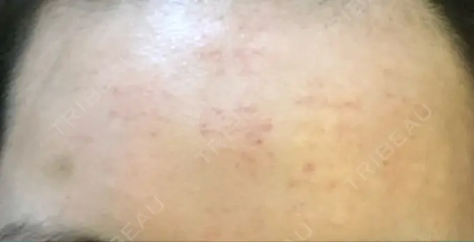 水光注射（ハリ・美肌） プチパーティー医院 DAY 2 メイン用