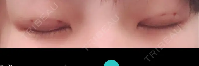 二重埋没 湘南美容クリニック 京都院 DAY 0 メイン用