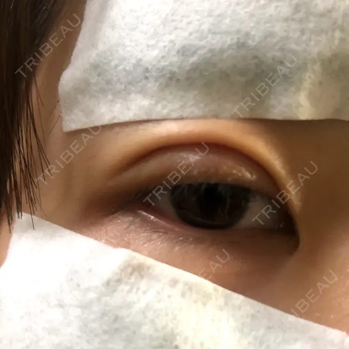 二重埋没 湘南美容クリニック 京都院 DAY 0 メイン用